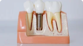£40 Fixed Competitive Price for Tooth Implant