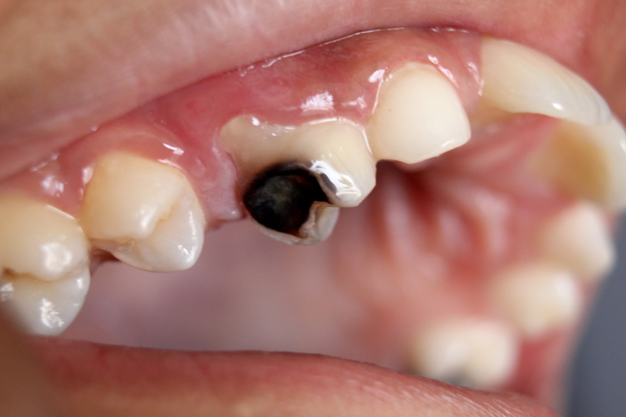 Everything you need to know about tooth decay and cavities!